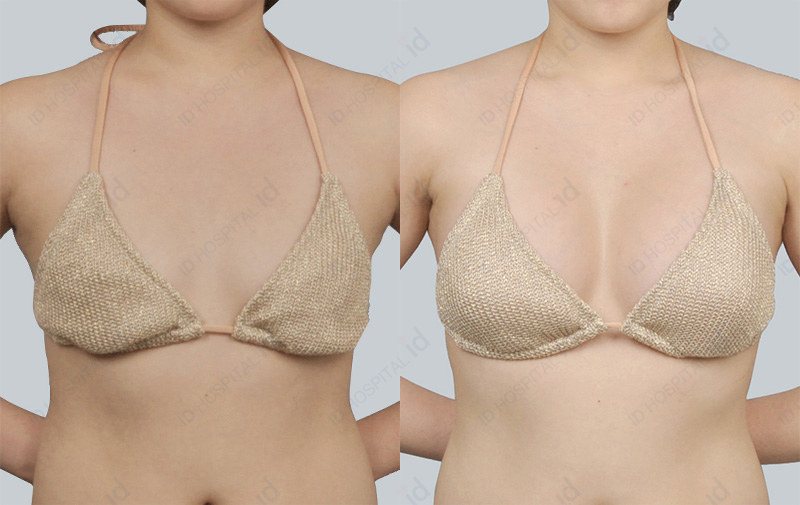 Breast augmentation