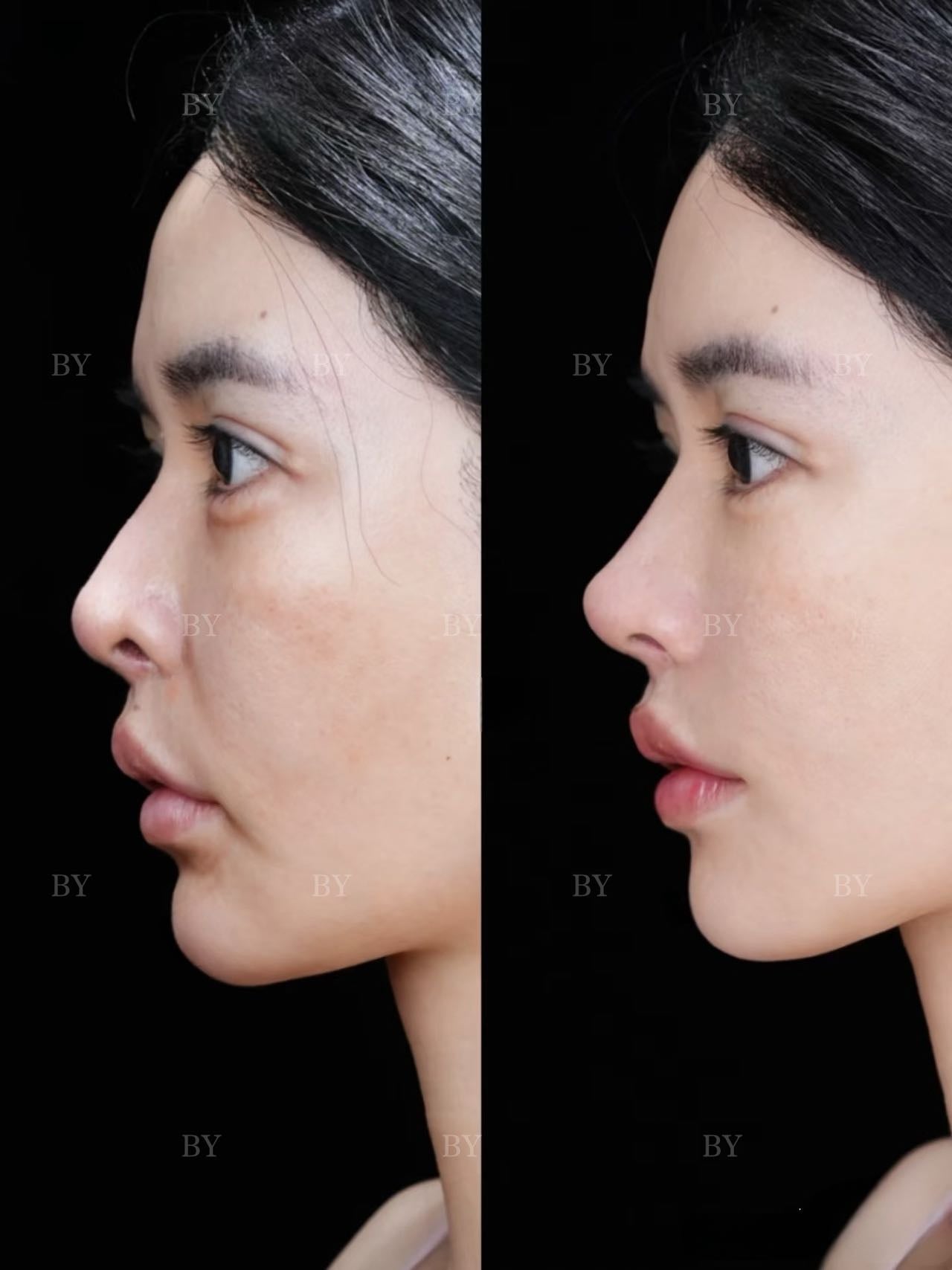 Rhinoplasty