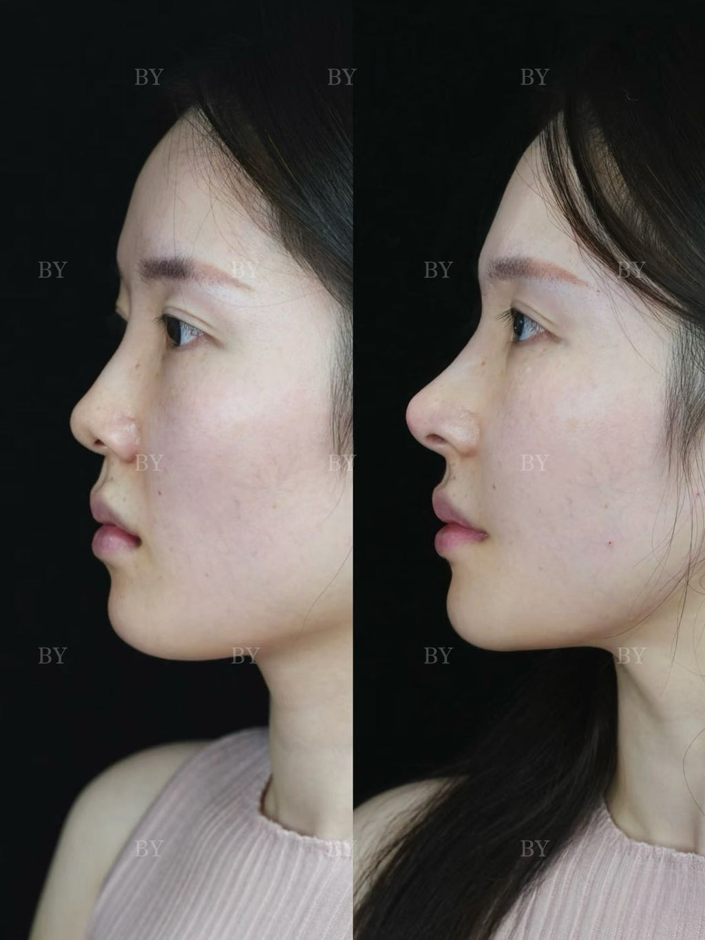 Rhinoplasty