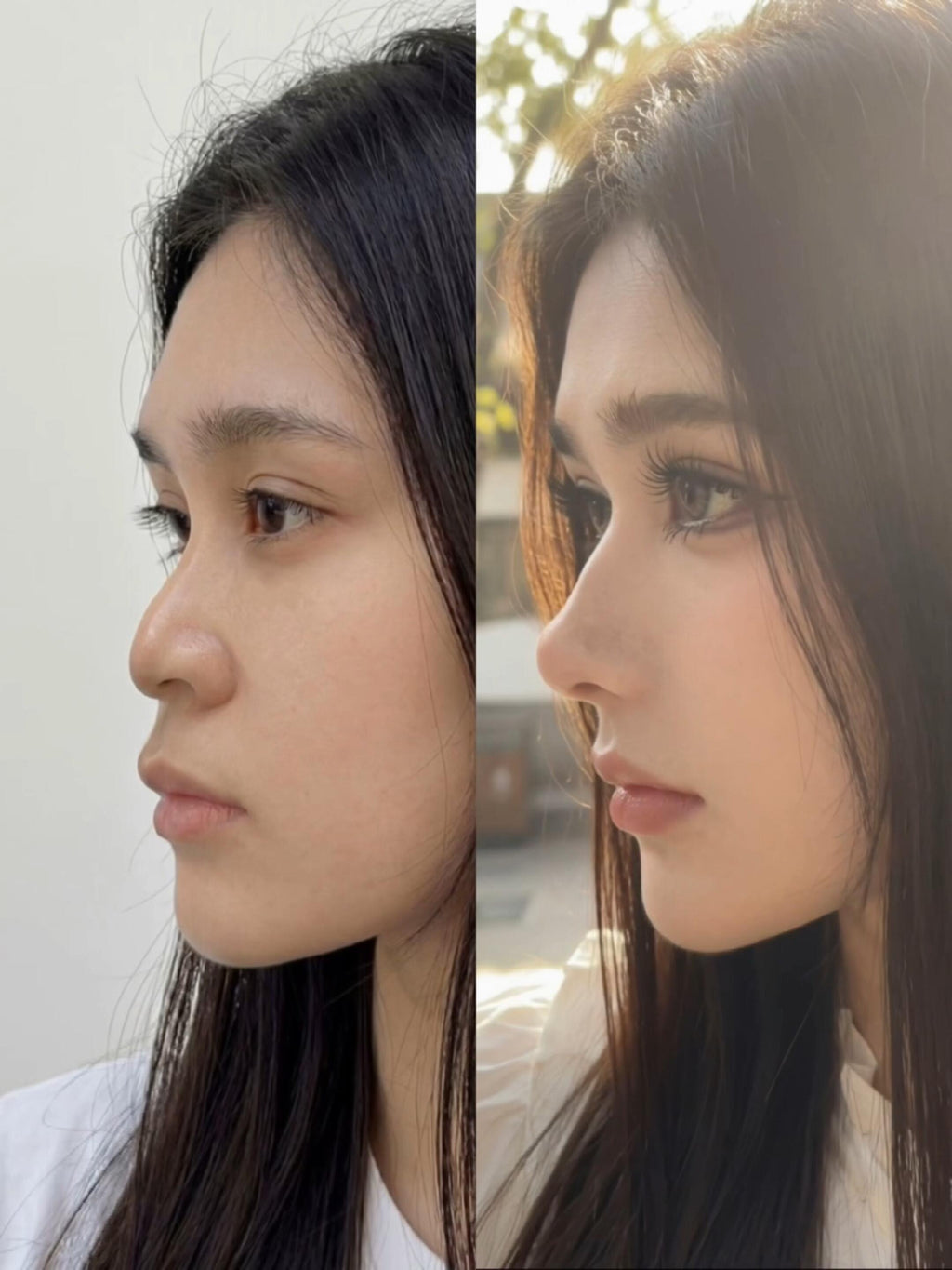 Rhinoplasty