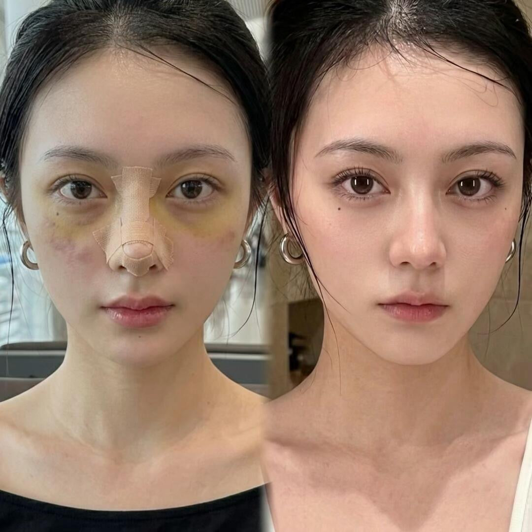 Rhinoplasty