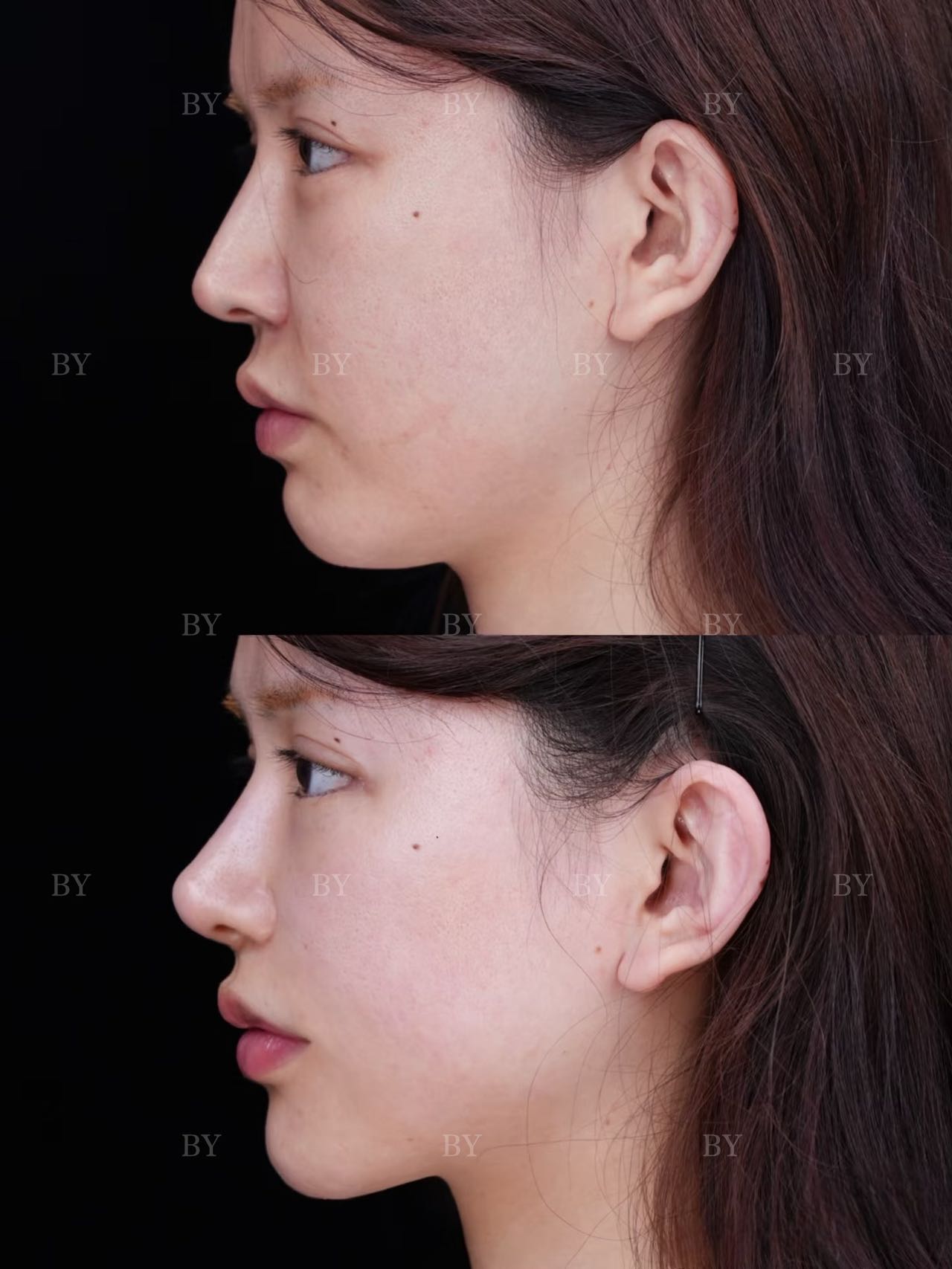 Rhinoplasty