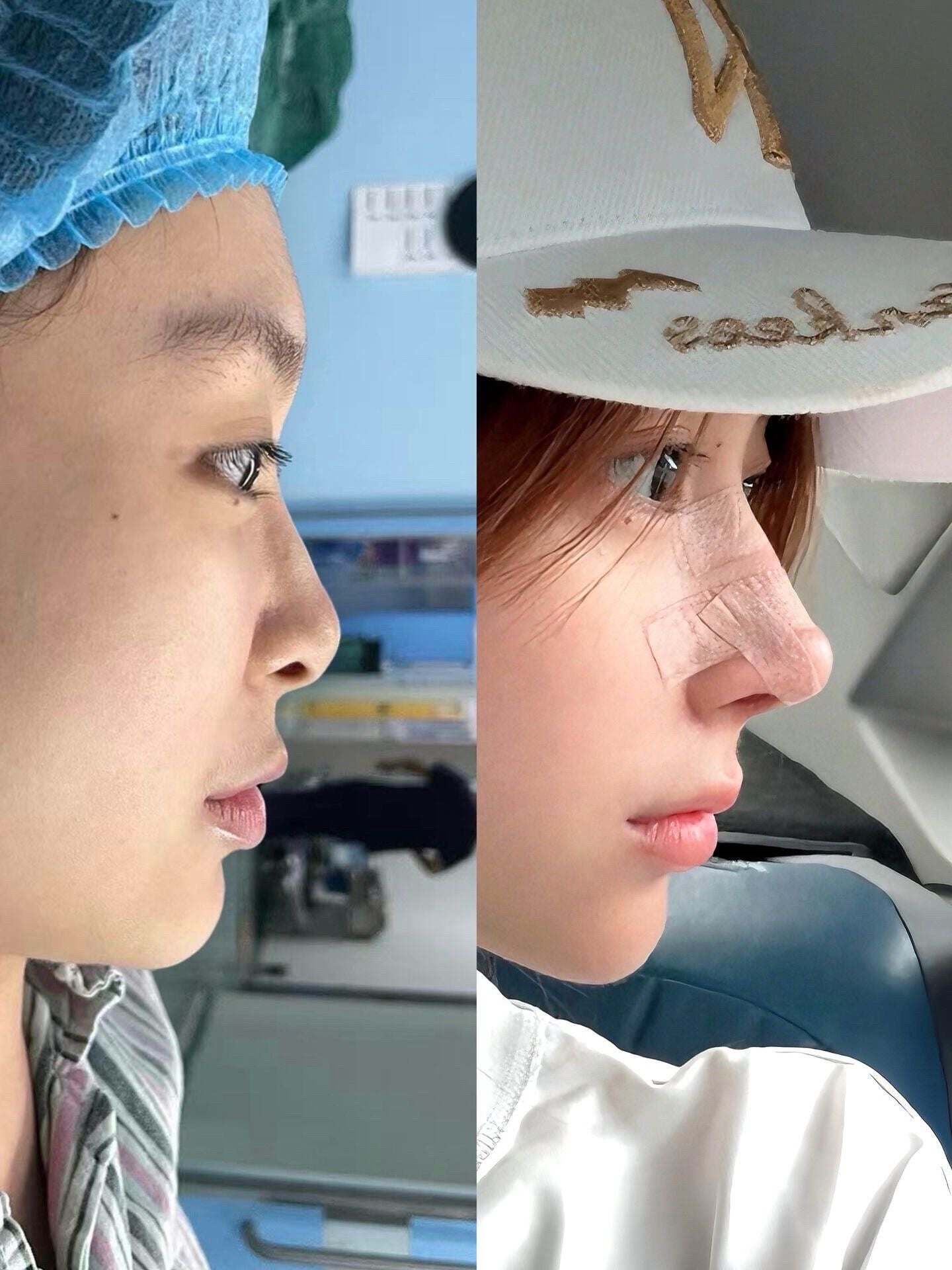 Rhinoplasty