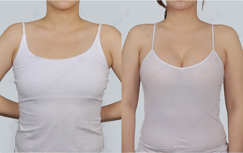 Breast augmentation