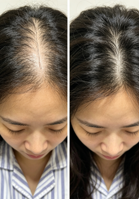 hair Transplant