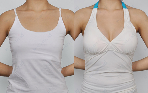 Breast augmentation